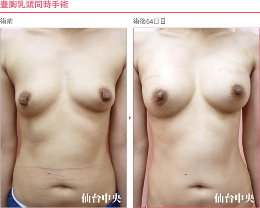 豊胸乳頭同時手術 症例写真