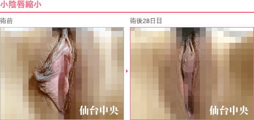 小陰唇縮小 症例写真