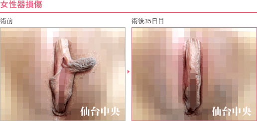 女性器損傷 症例写真